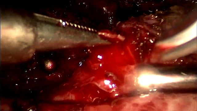 истмоцеле смотреть онлайн