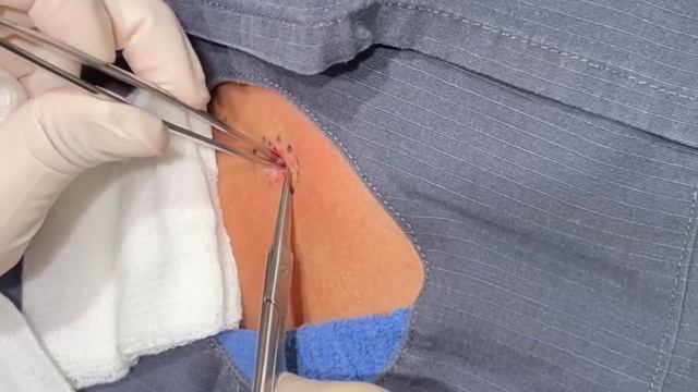 Don't Mess With This Cyst смотреть онлайн