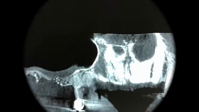 Sinus Floor Reconstruction Lateral Sinus Lift - Stephane Berg DDS смотреть онлайн