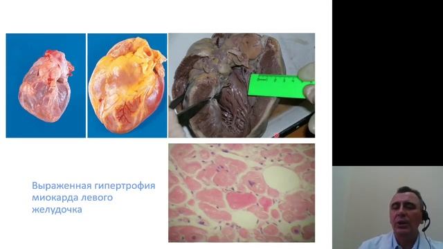 Патанатомия 8.Болезни сердечно сосудистой системы смотреть онлайн
