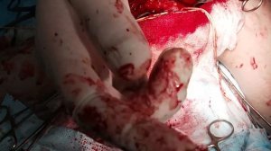 Тромбэктомия.Thrombectomy.Тромбэктомия из подколенной артерий. Дьячков А.В.