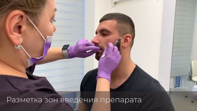 Коррекция носогубных складок смотреть онлайн