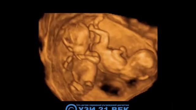 3д УЗИ - многоплодная беременность смотреть онлайн