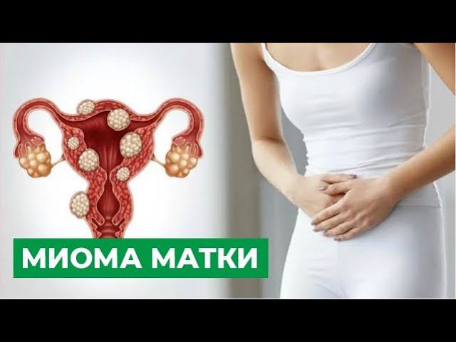 Миома матки: причины, симптомы. Лечение миомы матки. смотреть онлайн