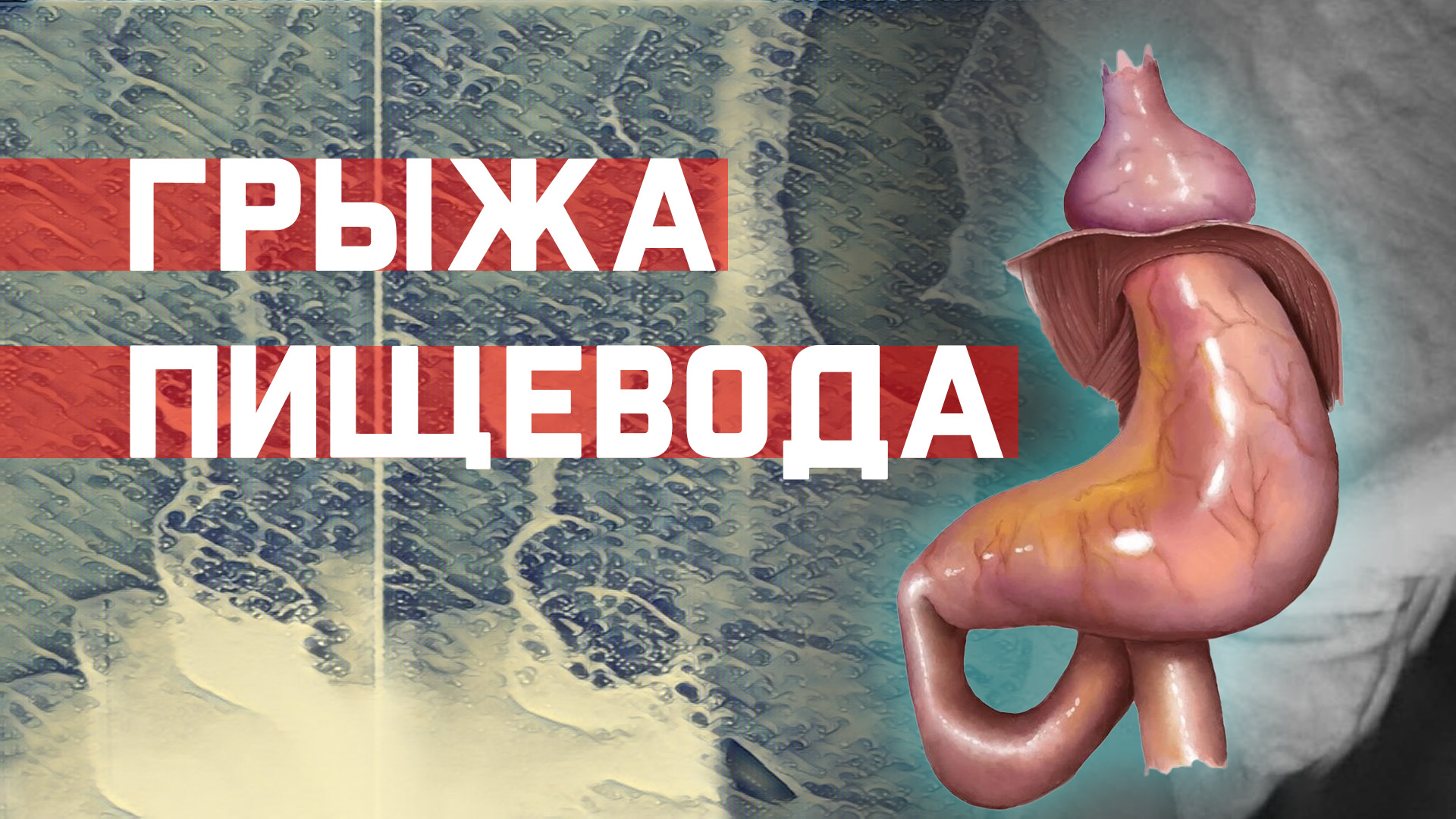 Грыжа пищеводного отверстия. Какие упражнения могут помочь?