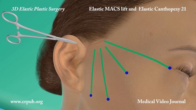 51. Elastic MACS Lift And Elastic Canthopexy