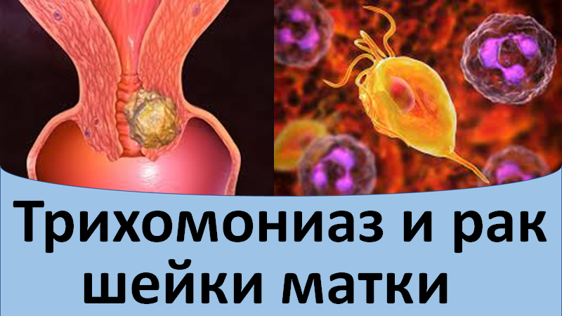 Трихомониаз и рак шейки матки смотреть онлайн