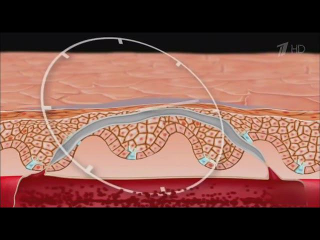 Удаление сосудов смотреть онлайн