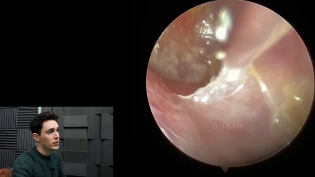 Sodium Bicarbonate Drops VS Earwax & Dead Skin смотреть онлайн