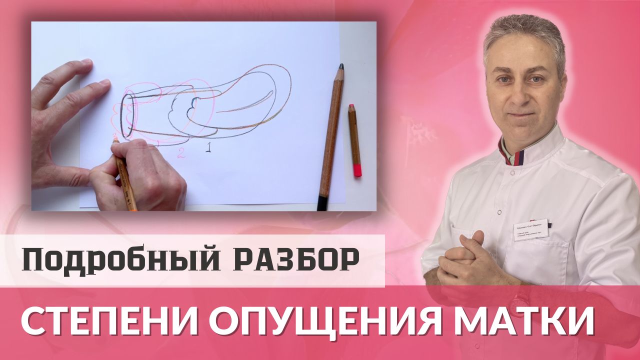 Опущение Матки. Подробное видео о трех степенях опущения матки смотреть онлайн