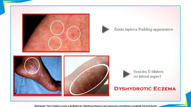 Experts speak: Fungal infection, its causes & treatment смотреть онлайн