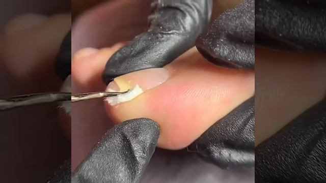 Установка тампонады для вросших ногтей в студии 4OCUS_nails смотреть онлайн