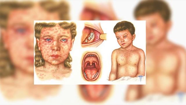 Отправляясь за границу - сделайте прививку от кори. смотреть онлайн