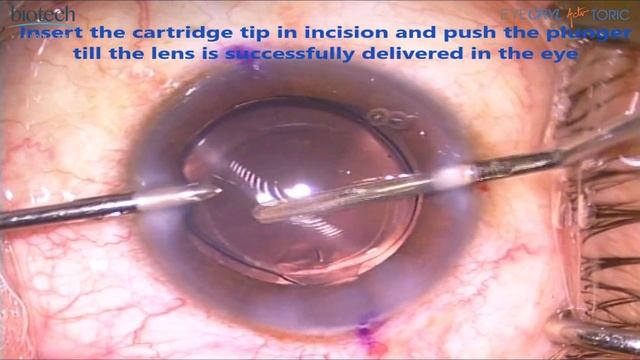 EYECRYL ACTV TORIC _ NEW смотреть онлайн