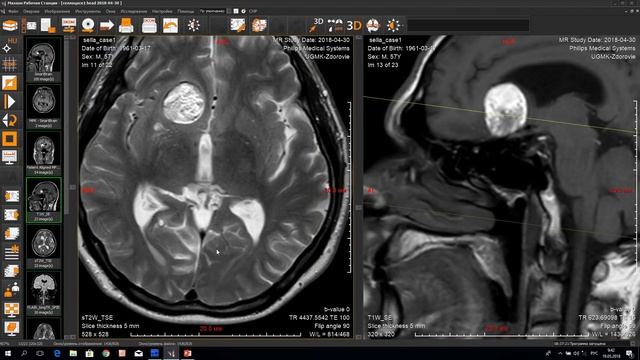 Светлана Кузнецова. Нейрорадиология - селлярная/параселлярная локализация. смотреть онлайн