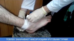 Спиральная повязка большого пальца нижней  конечности