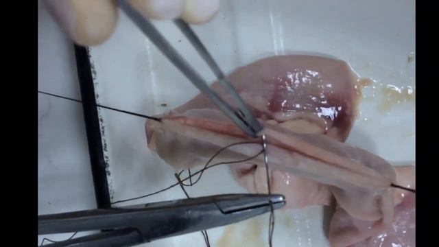 Резекция тонкой кишки.Формирование анастомоза бок в бок. смотреть онлайн