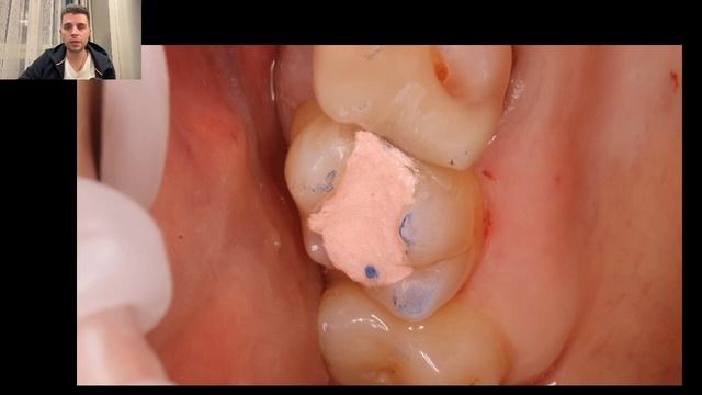 Уроки эндодонтии. Распространенная причина боли при накусывании после проведенного лечения смотреть онлайн