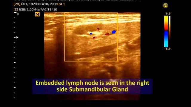 Ultrasound cases 83 of 2000 || Video Showing Inguinal and Submandibular Lymphadenopathy смотреть онлайн