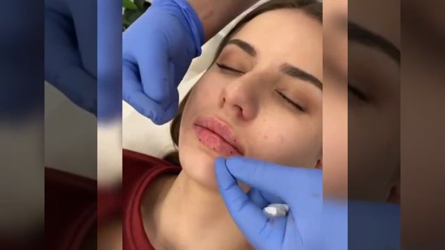 Как правильно разминать губы после увеличения. смотреть онлайн