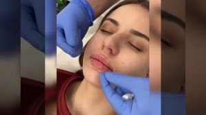 Как правильно разминать губы после увеличения.