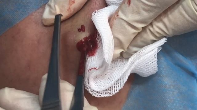 臉部粉瘤切除 美麗新城診所莊禮謙醫師 Minimal Incision, Epidermal Cyst, Dr George