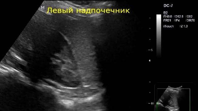 Надпочечники смотреть онлайн