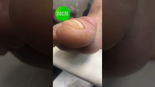 #микоз #москва #педикюр #подолог #подология