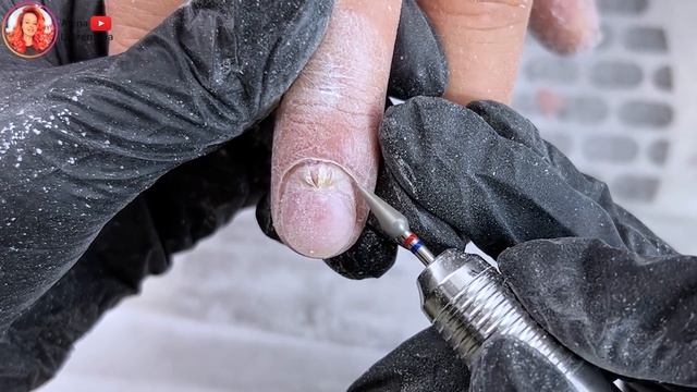 Трещина у кутикулы / Онихорексис - трещина на ногте