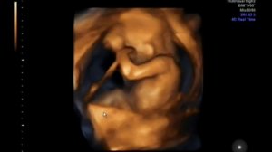 УЗИ 11.12.19 - 16-17 недель