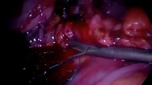 Ушивание перфоративной язвы желудка