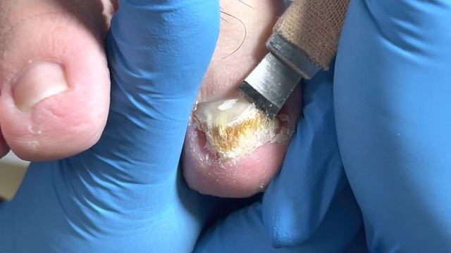 Fungal Infection Of Onychomycosis, The Nail Bed Peels Off Layer By Layer【Pedicure Master Lin Jun】