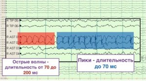 ЭЭГ-8. Эпилептиформная активность. Интериктальная активность.