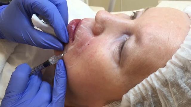 Контурная пластика в центре косметологии "Сезон Красоты" смотреть онлайн