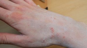 Чесотка / Scabies