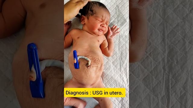 Prune Belly Syndrome.Eagle Barrett Syndrome.Genetic disorder of newborn. смотреть онлайн