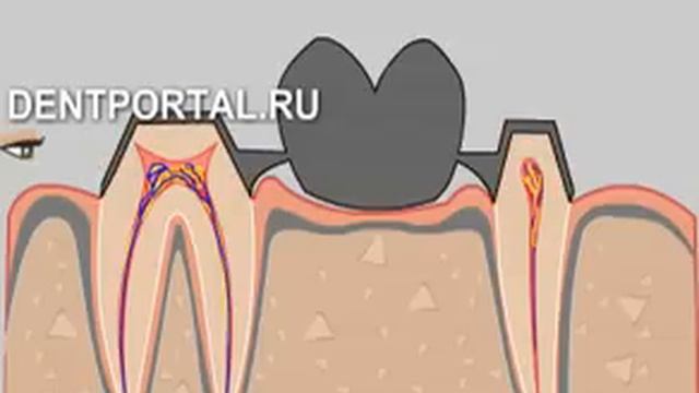Проблемы несъемного протезирования зубов смотреть онлайн