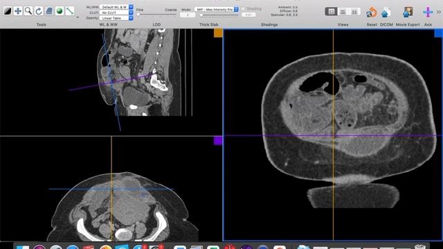 | GIT | ER | IO | obstructing incisional hernia | Reporting Simulation | 2| смотреть онлайн