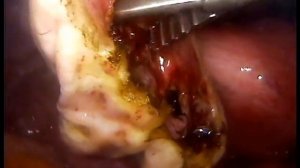 Киста левого яичника (лапароскопия в клинике "РосМед")