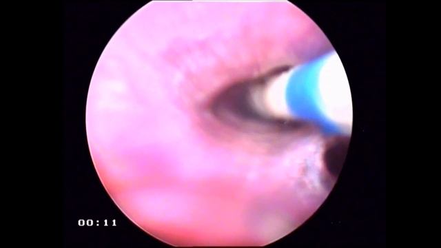 Стентирование бронха у собаки. Stenting of the bronchi in dog. смотреть онлайн