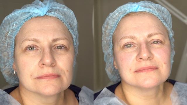 Неодимовое омоложение в Кудрово