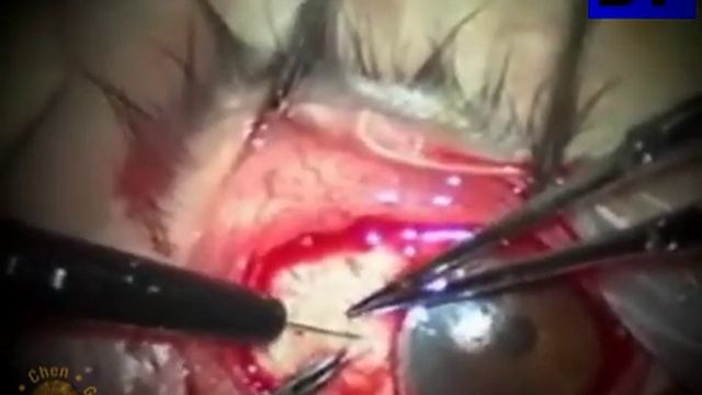Хирургия глаукомы  (Glaucoma Surgery) - 14