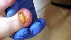 Онихогрифозный ноготь после зачистки🦶🏻💯 • ЧАСТЬ 2