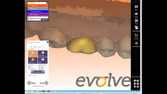 Condor scan in Exocad смотреть онлайн