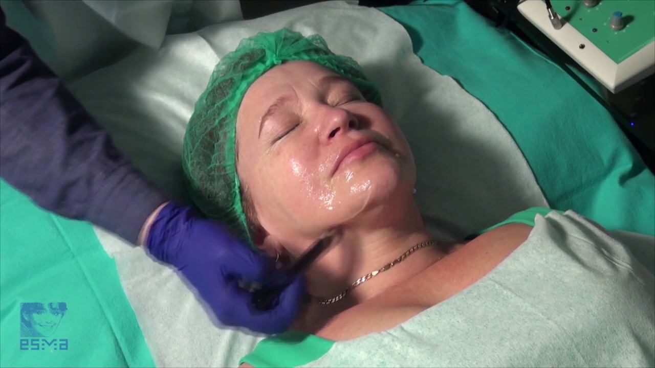 Classic lifting procedure with sample P1 смотреть онлайн