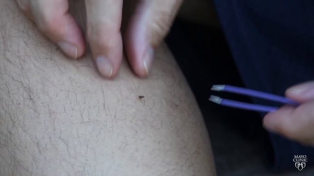 Mayo Clinic Minute: Tips to best remove ticks смотреть онлайн
