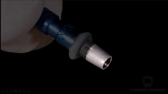 Сравнение аналогового метода протезирования на имплантатах и цифрового протокола CEREC смотреть онлайн