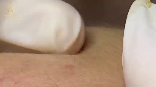 Blackhead Removal With Sac Dep Spa @1000642