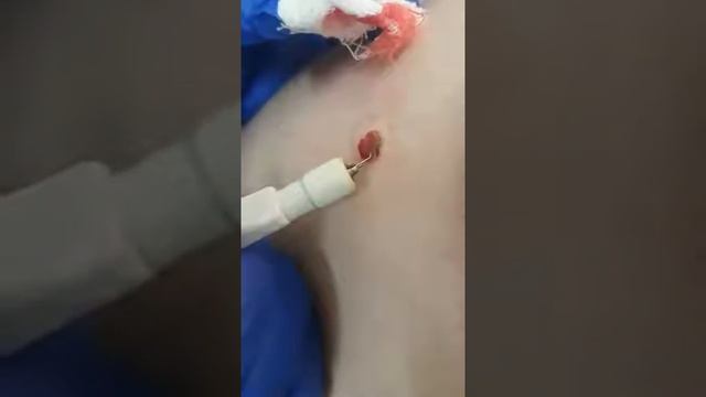 Удаление родинок МистерДент ,  Removal Of Skin Tumors , удаление новообразований на коже