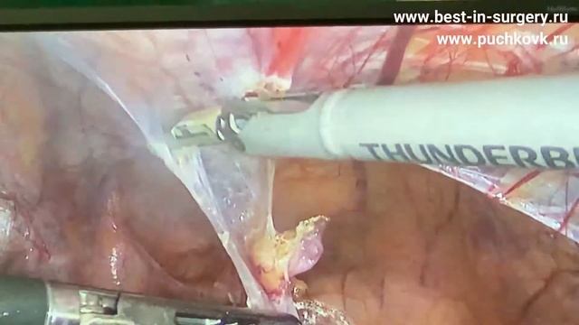 Лапароскопическая герниопластика. Двусторонняя паховая грыжа смотреть онлайн